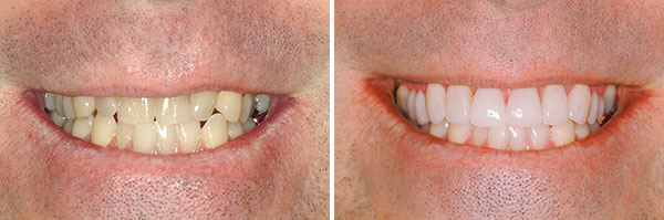Carillas Lumineers 2 Clínica Dental CCEO. Antes y después