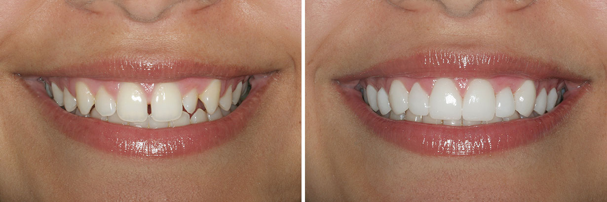Before - after. Lumineers 2 vareers. Dental Clinic CCEO Alicante. Photo: DenMat